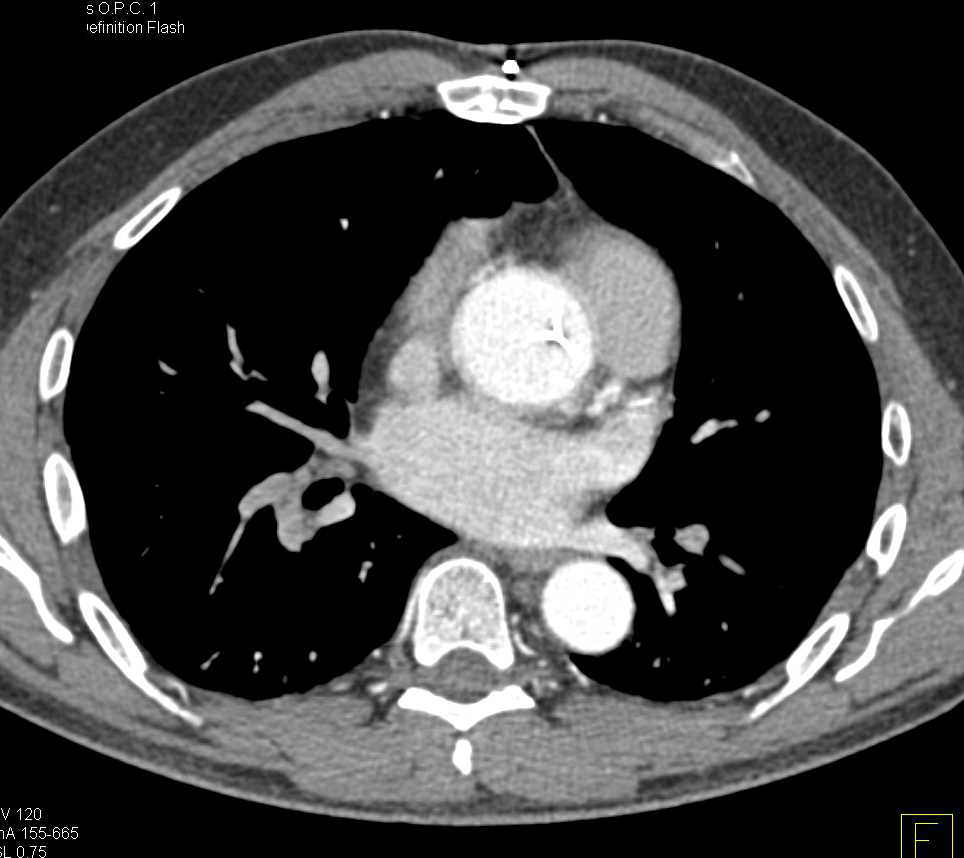 CTA of Aortic Valve Replacement Study - CTisus CT Scan