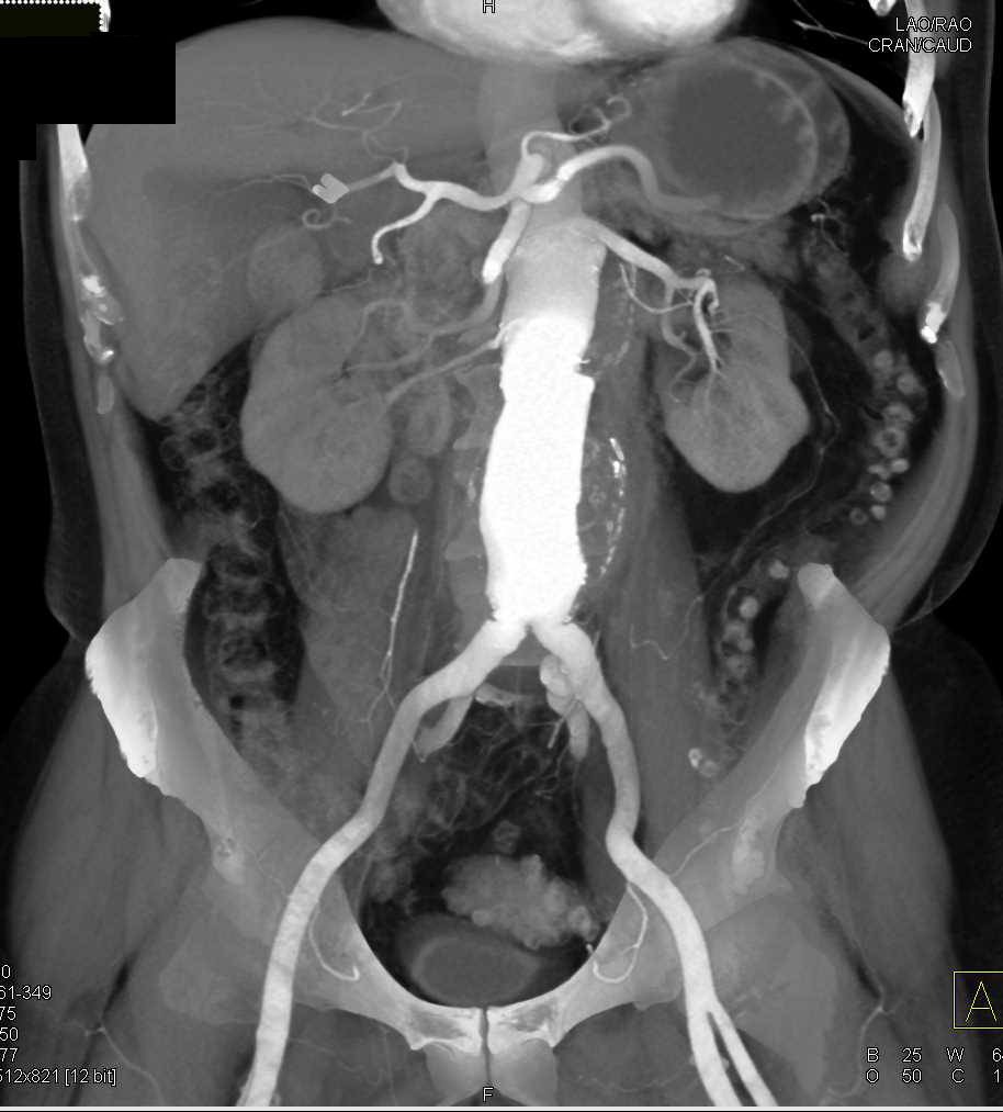 Abdominal Aorta CT Scan