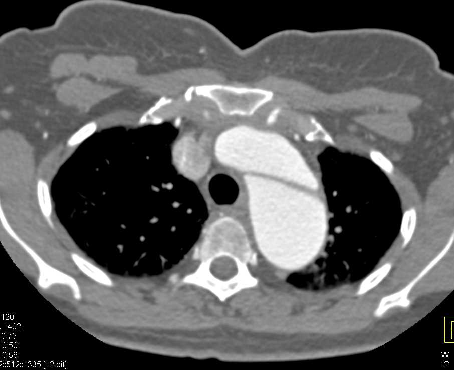 Type B Dissection with Nice Definition of True and False Lumen and Branch Vessels - CTisus CT Scan