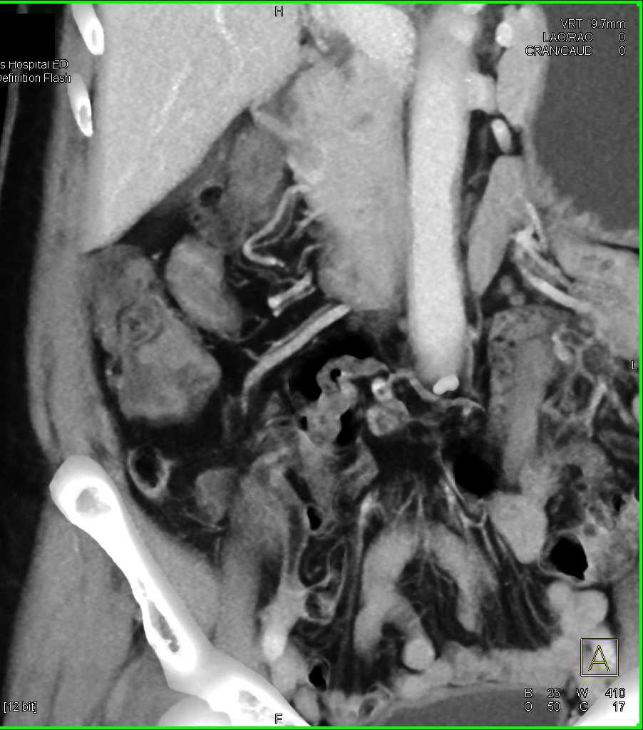 Takayasu's Arteritis - CTisus CT Scan