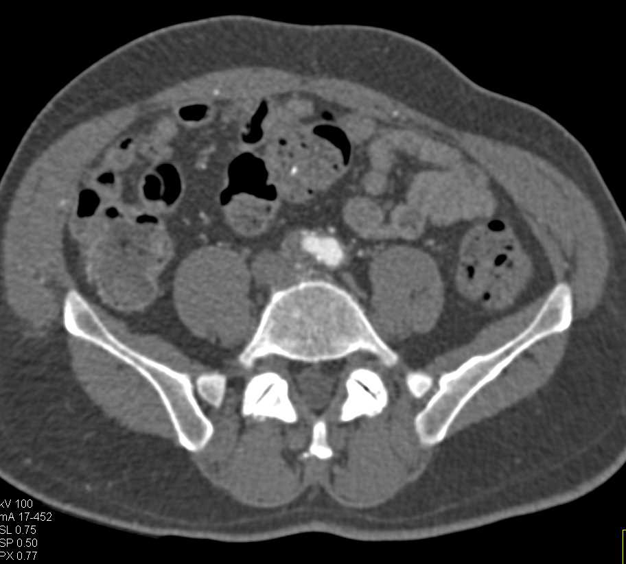 Occluded Right Common Iliac Arteries and Both Superficial Femoral Arteries (SFAs) in 3D with CTA - CTisus CT Scan