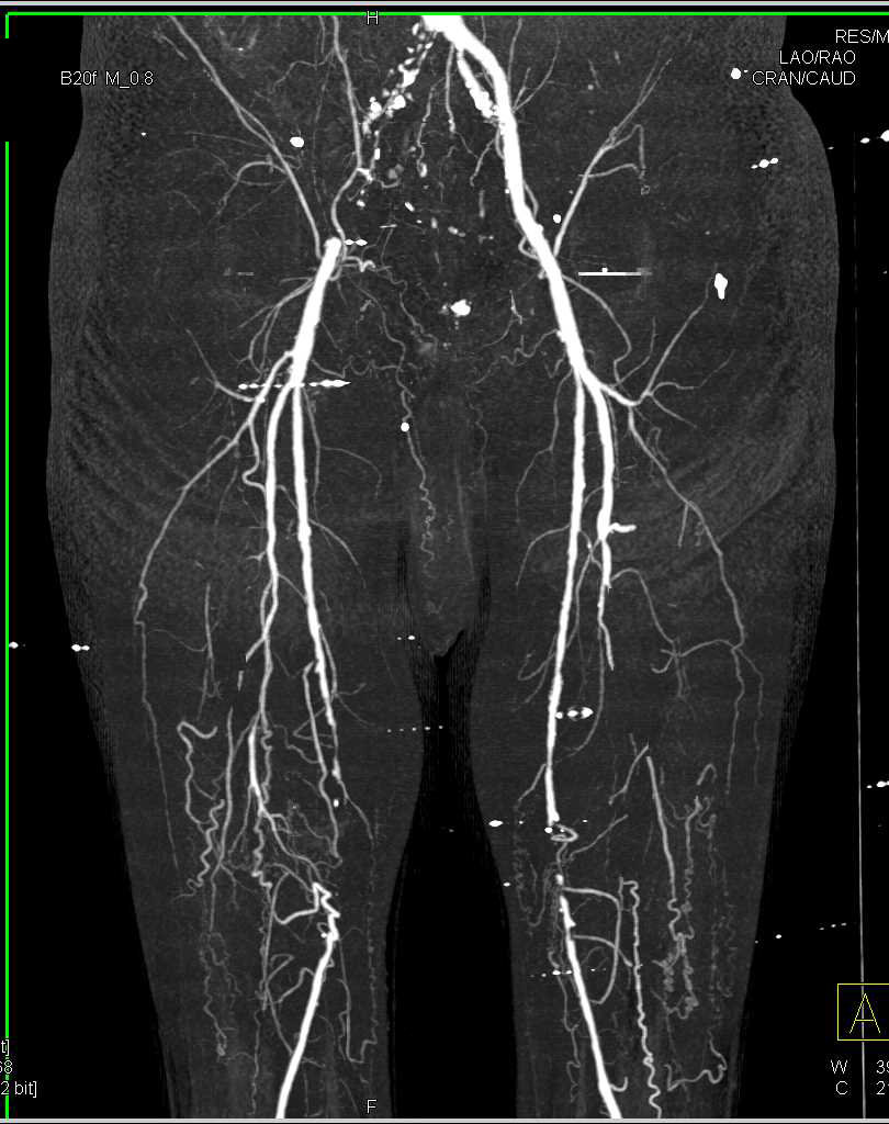 Occluded Right Common Iliac Arteries and Both Superficial Femoral Arteries (SFAs) in 3D with CTA - CTisus CT Scan