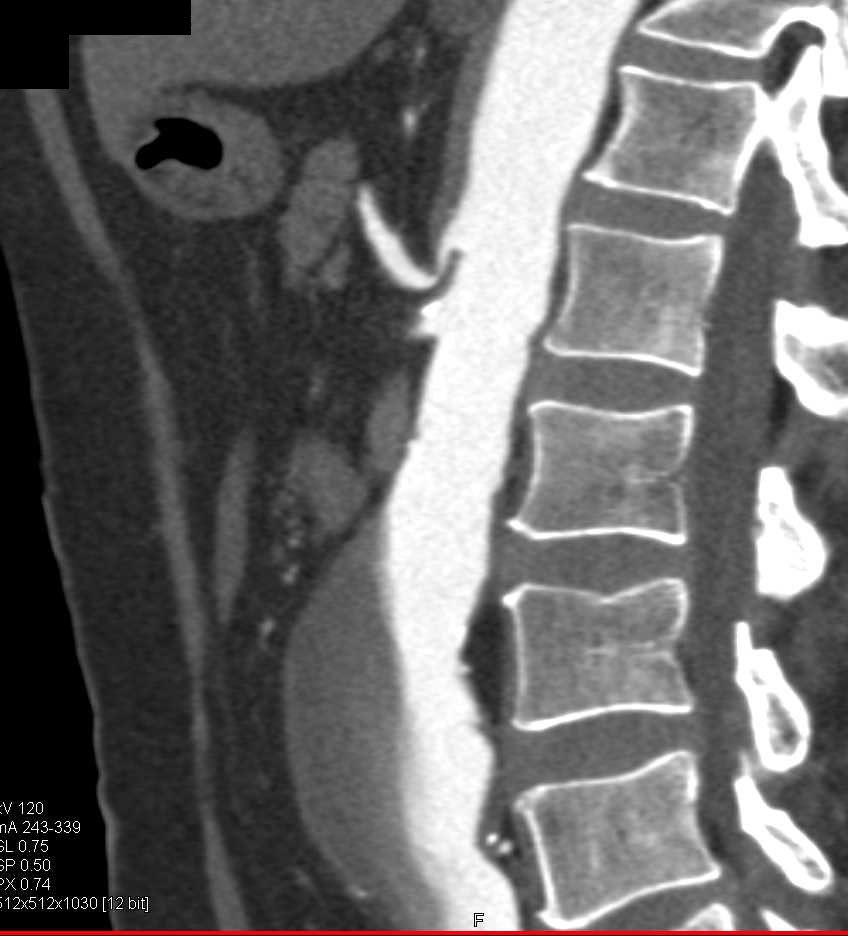 Celiac Stenosis and Superior Mesenteric Artery (SMA) Occlusion - CTisus CT Scan