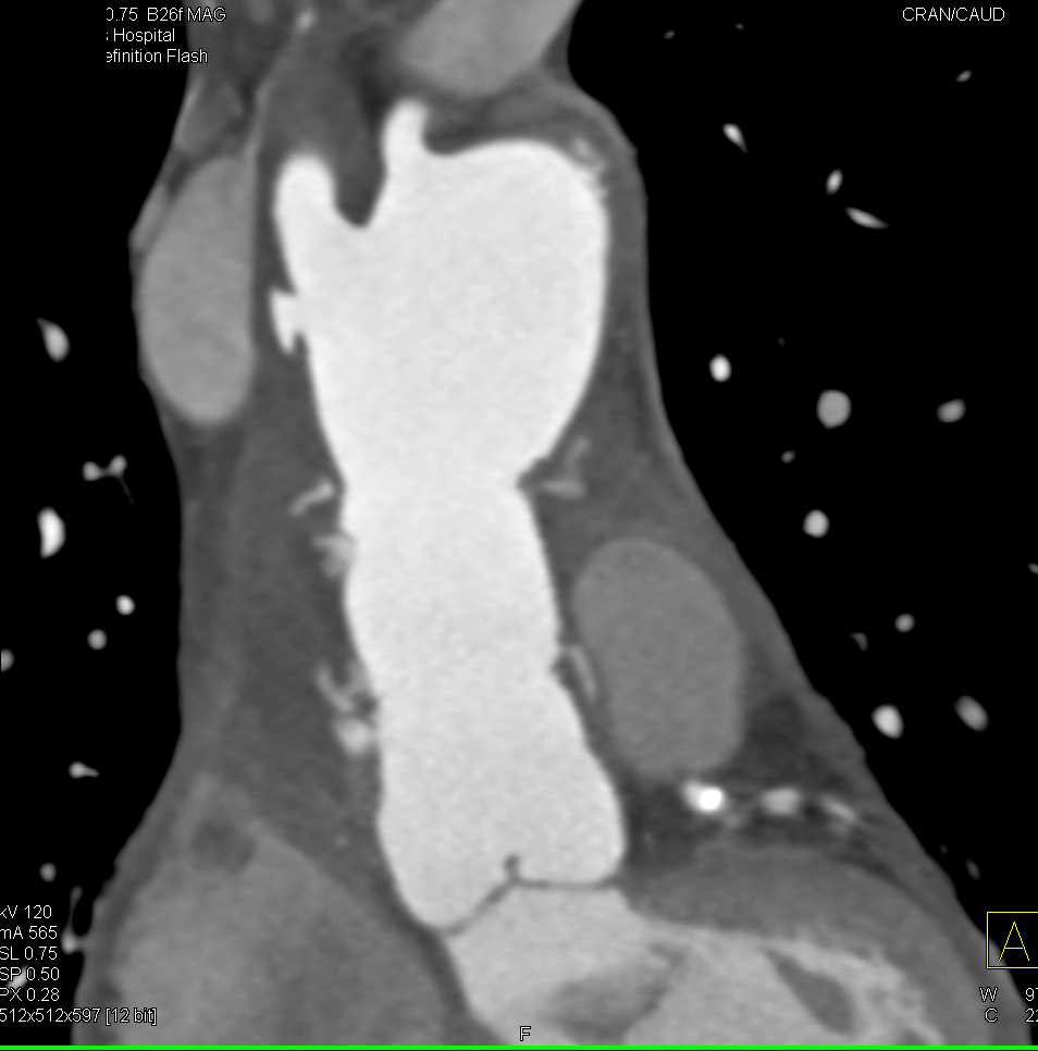 Ulcer in Ascending Aorta Simulates a Dissection - CTisus CT Scan