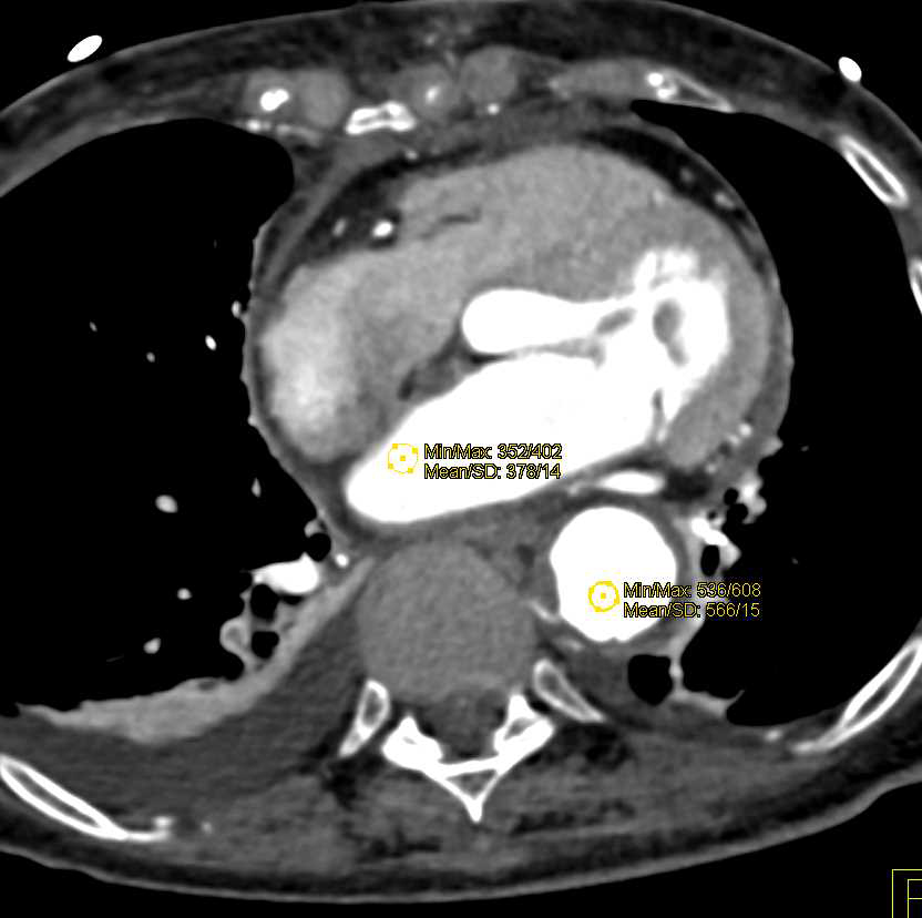 Ulcer in Ascending Aorta Simulates a Dissection - CTisus CT Scan