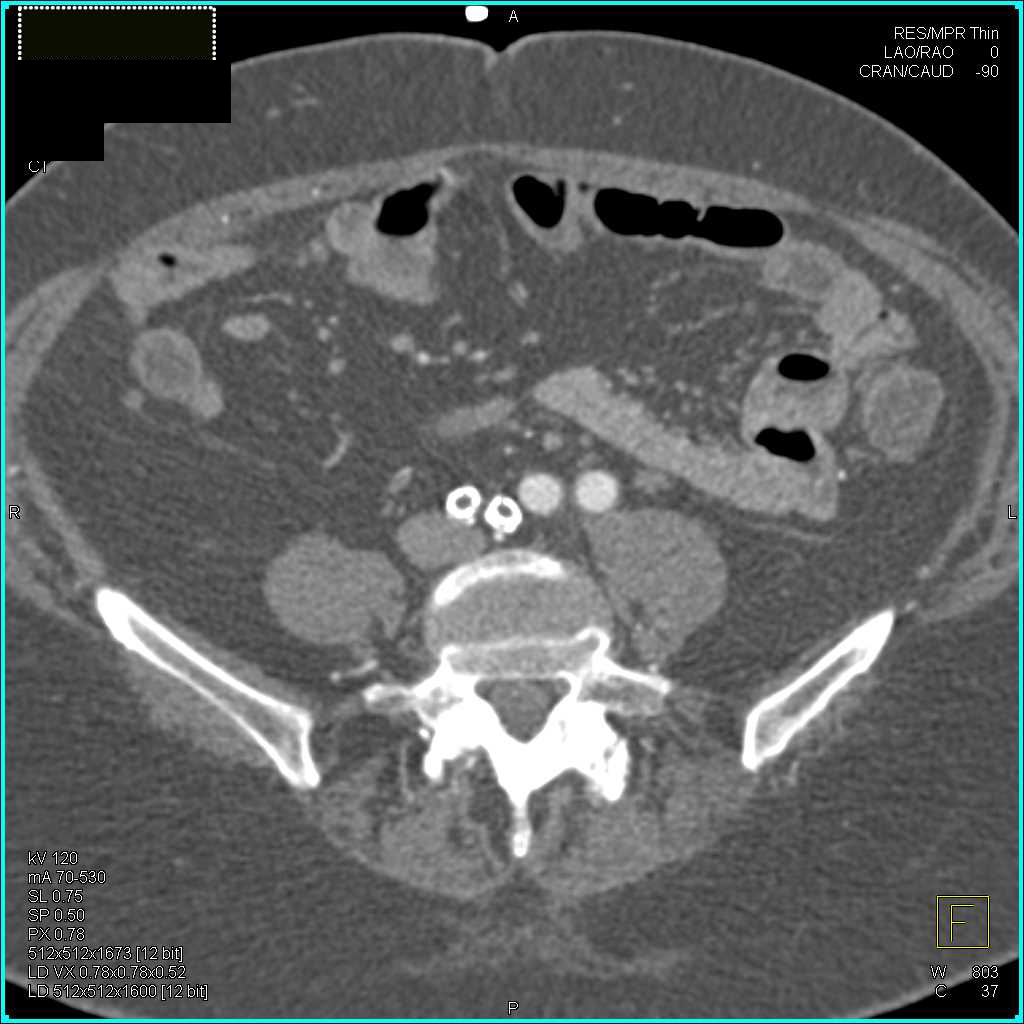 Vascular Pathology with Occlusion Dative Iliac Arteries and Severe Carotid Artery Stenosis - CTisus CT Scan