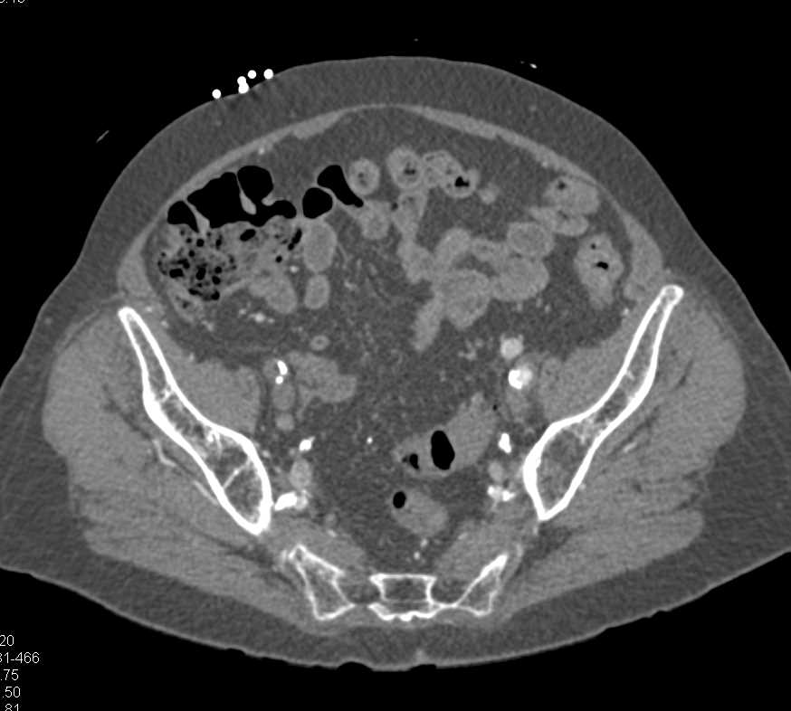 Aorrtic Aneurysm Repair with Graft and Extensive Native Vascular Disease - CTisus CT Scan