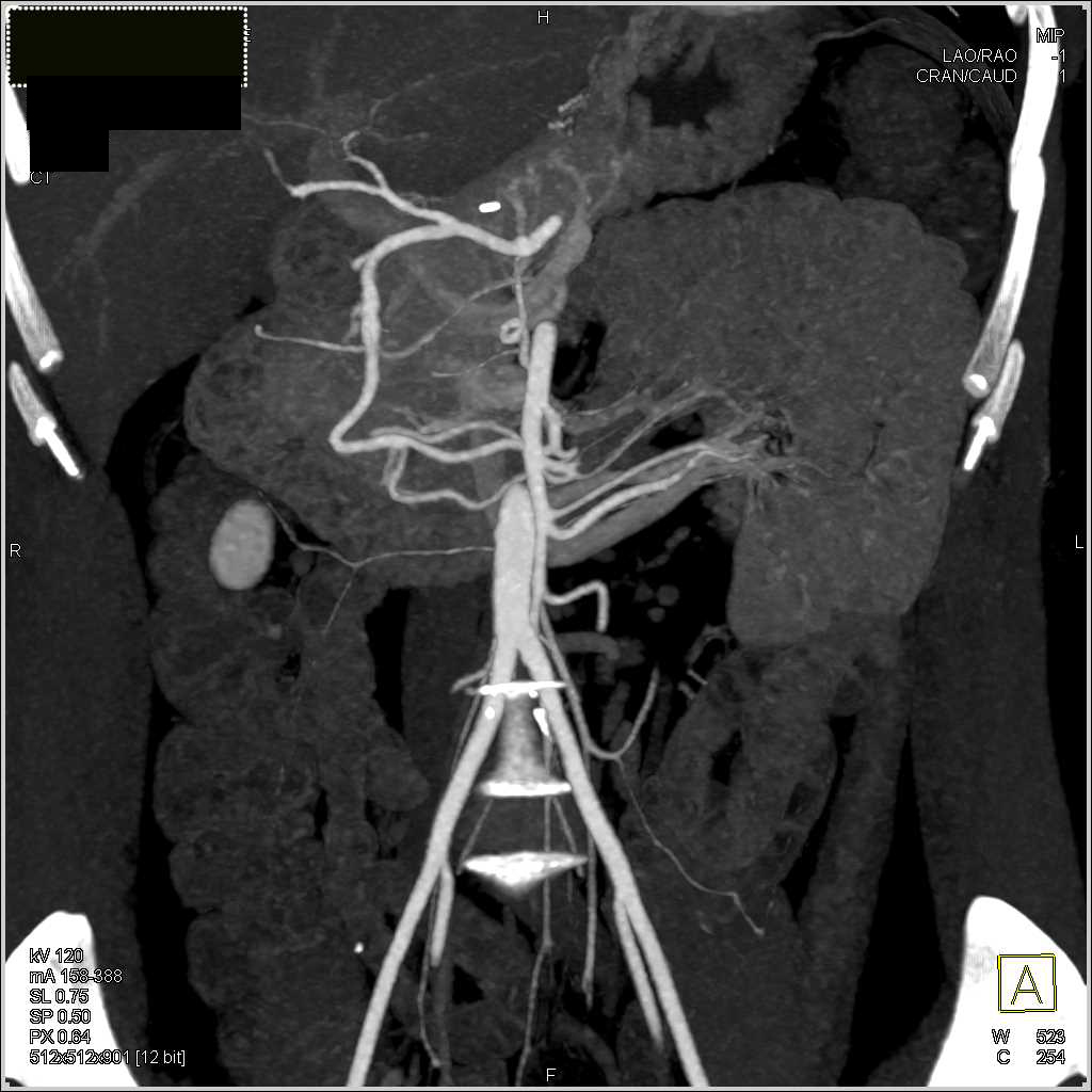 Occluded Celiac Artery Stent - CTisus CT Scan