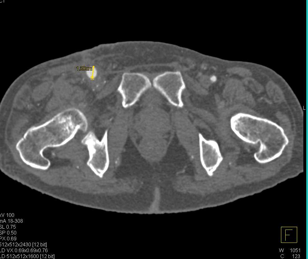 Aorta to Superficial Femoral Artery (SFA) Bypass Grafts with Runoff - CTisus CT Scan