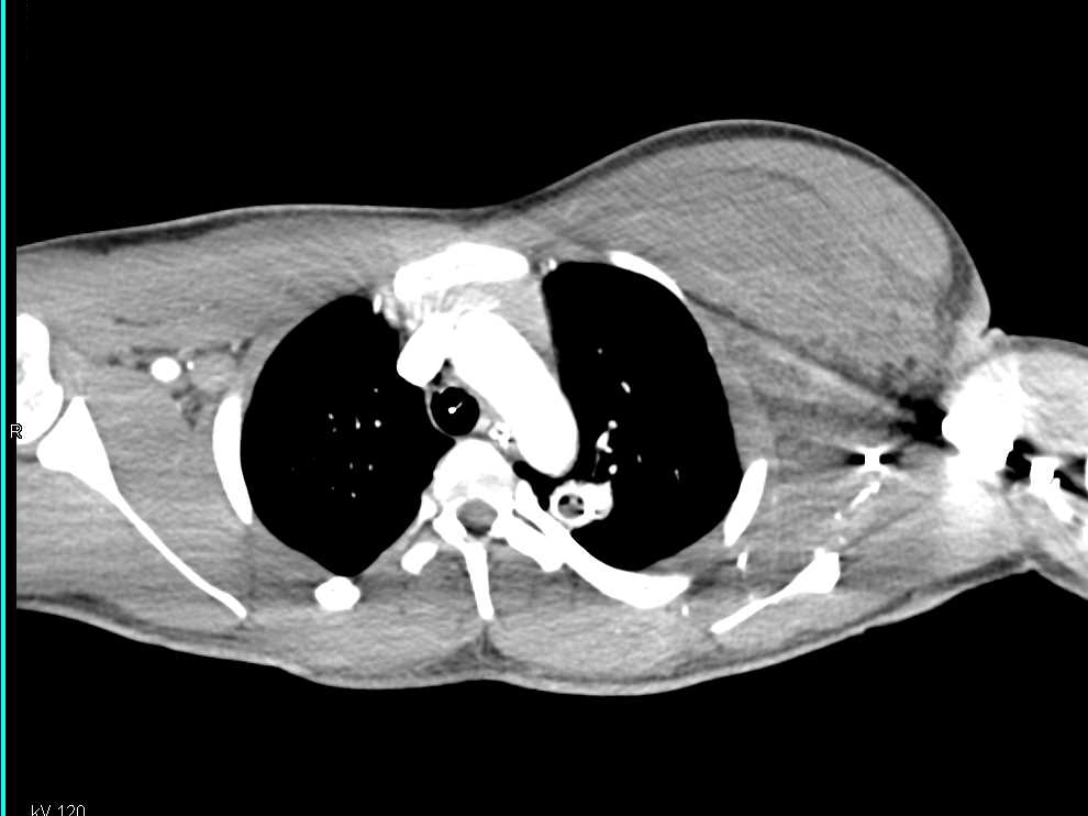 Trauma with CTA with Runoff and Multiple Sites of Vascular Injury - CTisus CT Scan