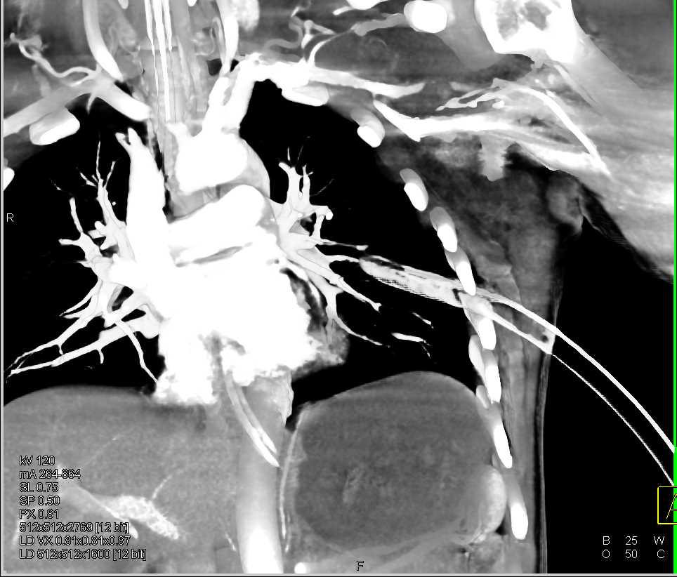 CTA Runoff with Superficial Femoral Artery (SFA) Spasm due to GSW - CTisus CT Scan
