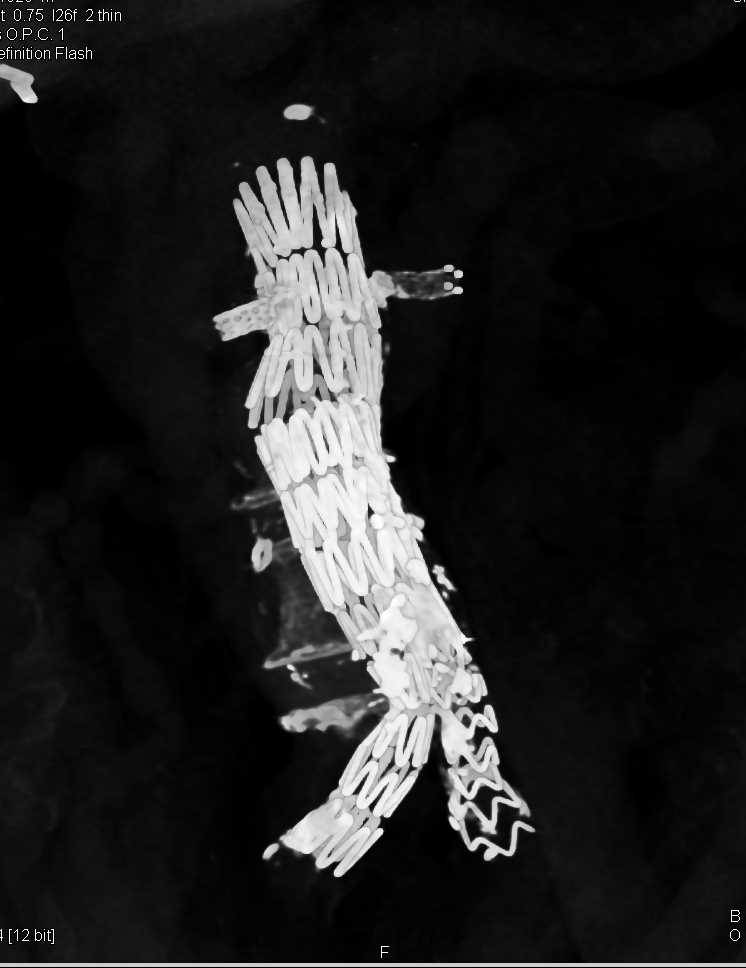 Endovascular Stent in 3D - CTisus CT Scan