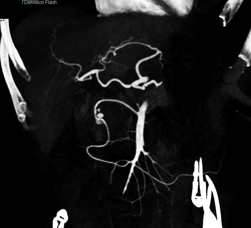 CTA with Gastroduodenal Artery (GDA) Bleed Seen Best on MIP Images - CTisus CT Scan
