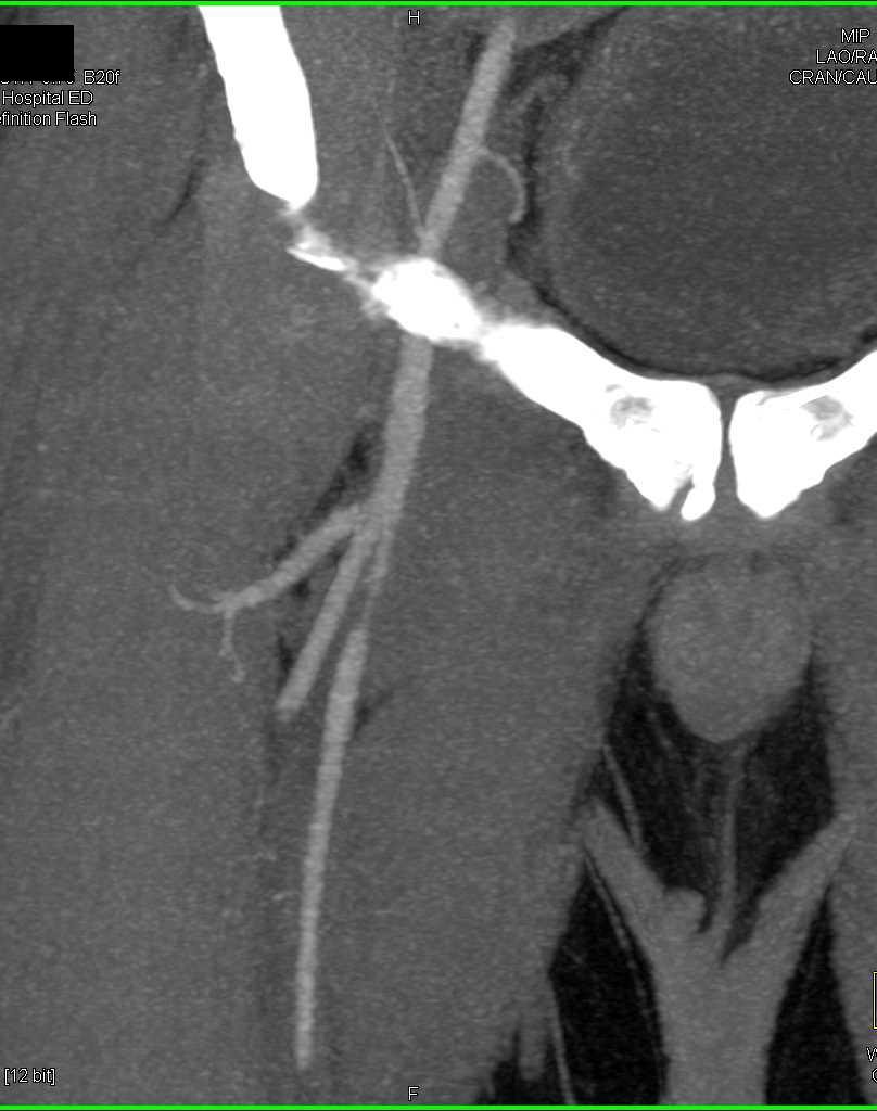 Superficial Femoral Artery (SFA) Stenosis - CTisus CT Scan
