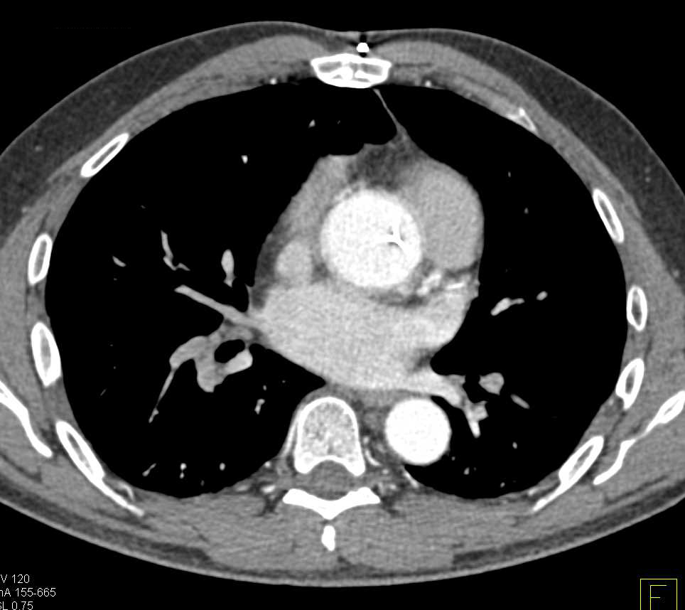 Aortic Valve Replacement Without Complication - CTisus CT Scan