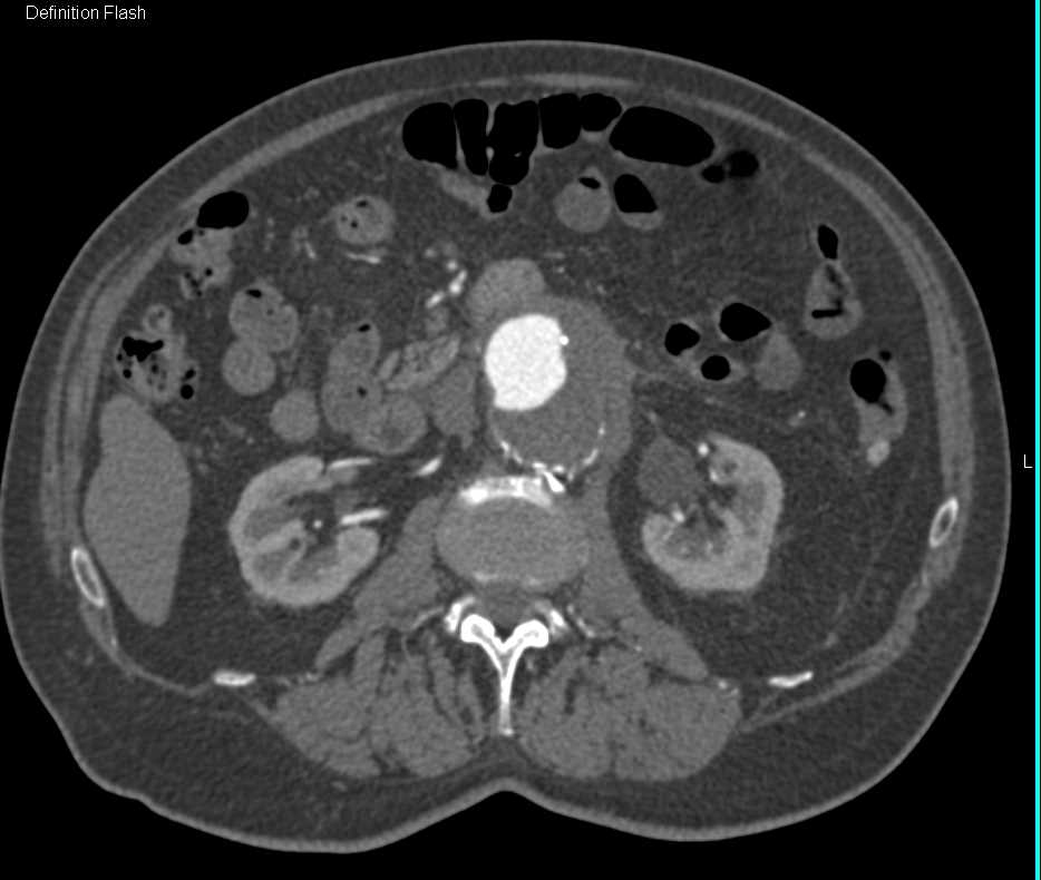 Abdominal Aortic Aneurysm with Prior Leak - CTisus CT Scan