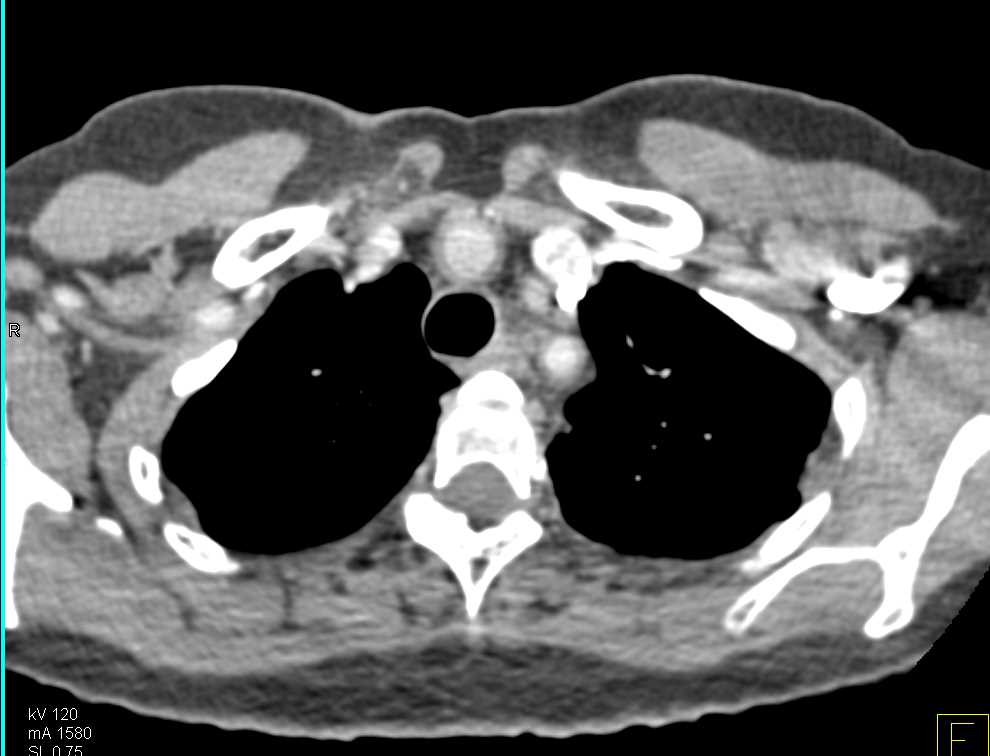 Takayasu's Arteritis - CTisus CT Scan