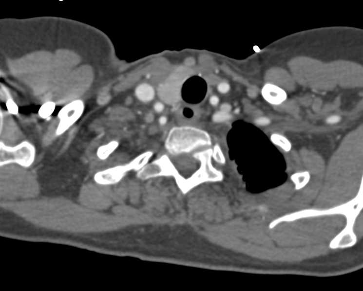 Graft to Left Axillary Artery - CTisus CT Scan