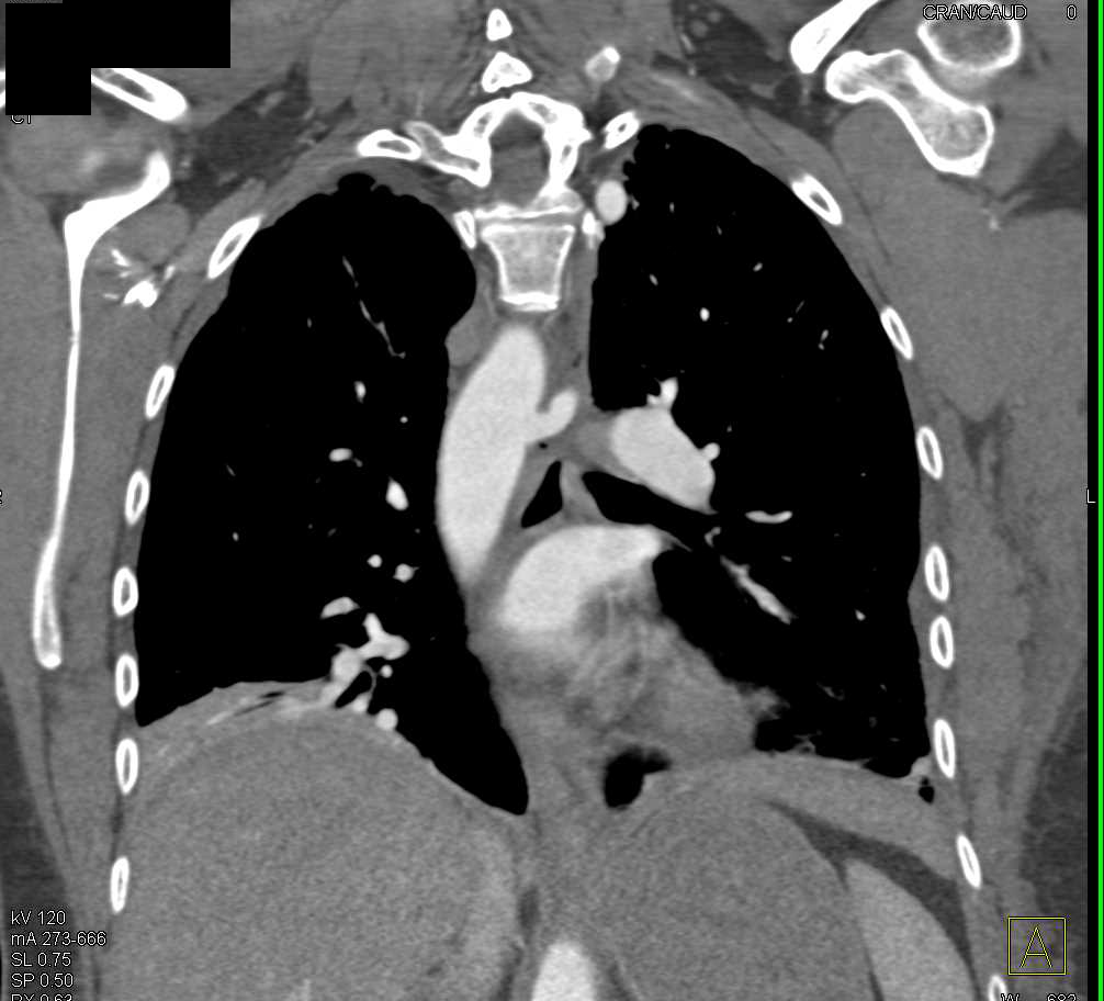 Graft to Left Axillary Artery - CTisus CT Scan