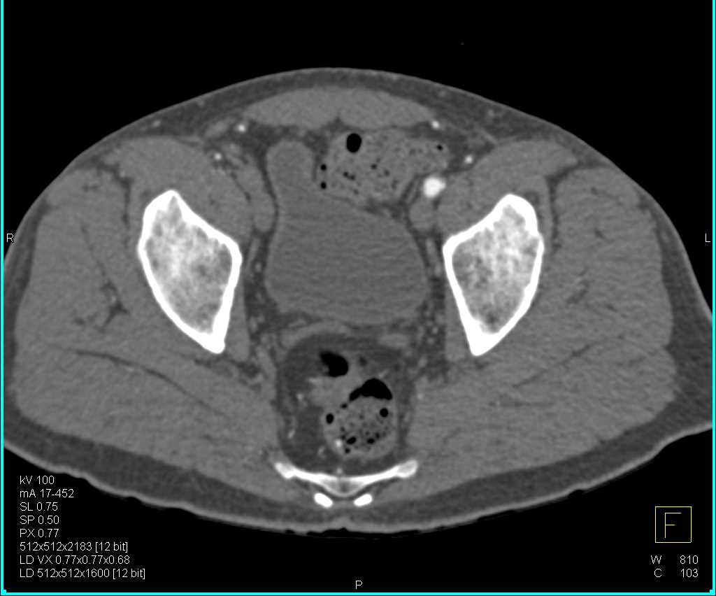 CTA DE Runoff with Occlusion of the Superficial Femoral Artery (SFA)'s Bilaterally - CTisus CT Scan