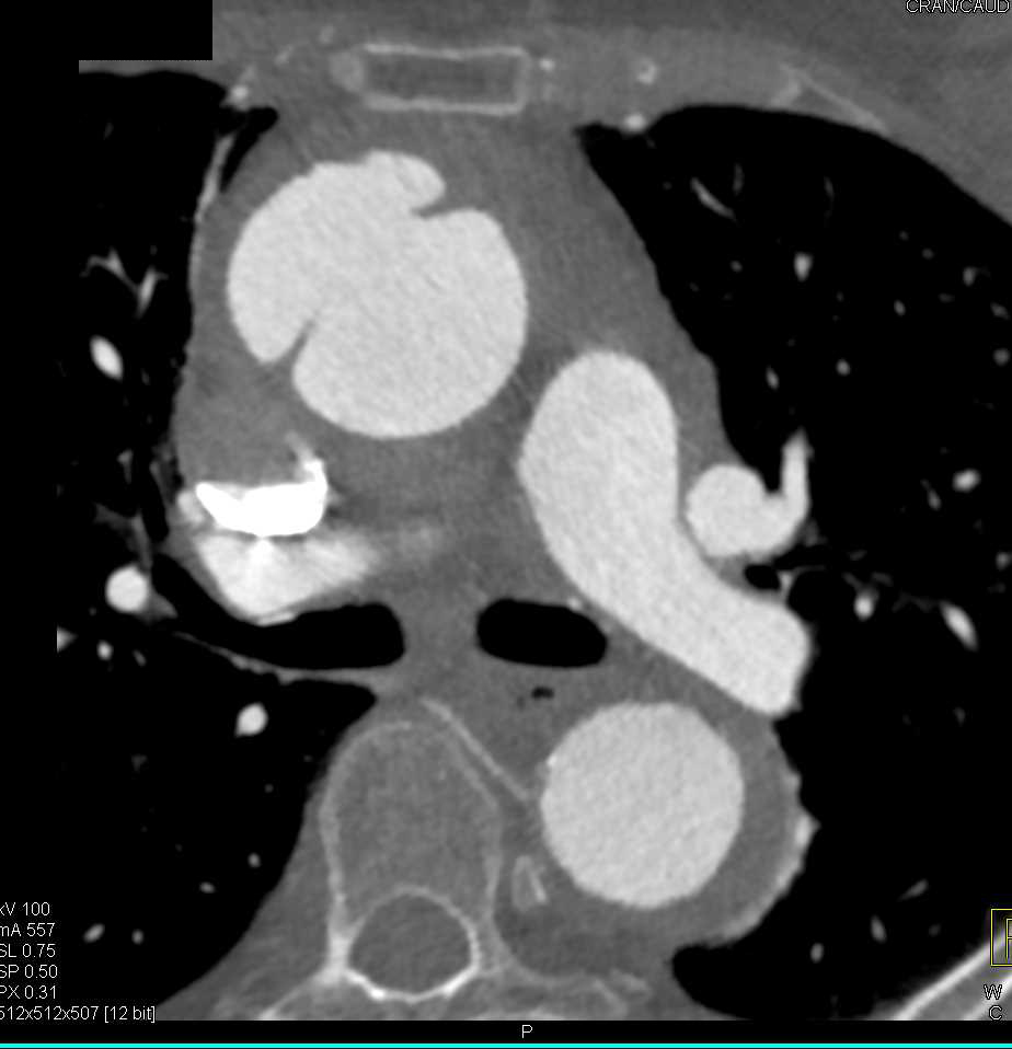 Focal Dissection Ascending Aorta - CTisus CT Scan