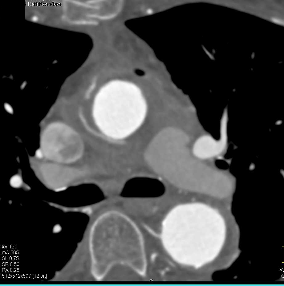 Ulceration in Ascending Aorta Simulates a Dissection - CTisus CT Scan