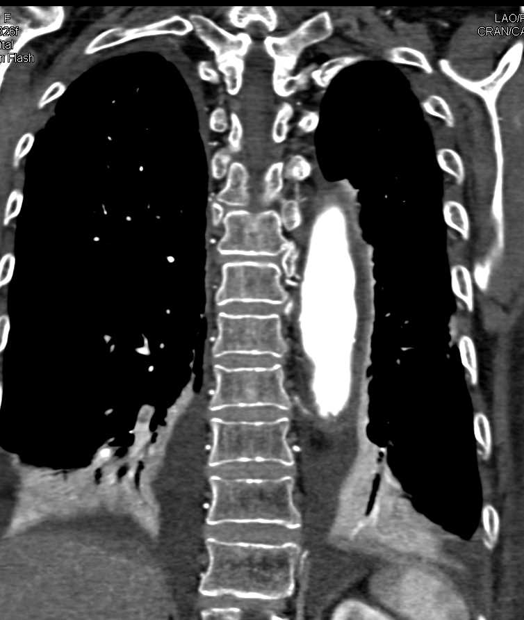 Adequate Opacification for a Triple Rule Out Study - CTisus CT Scan