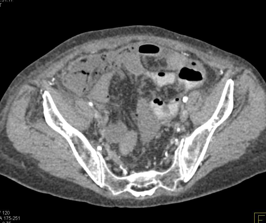 Ischemic Bowel due to Diseased Superior Mesenteric Artery (SMA) and Celiac Arteries - CTisus CT Scan