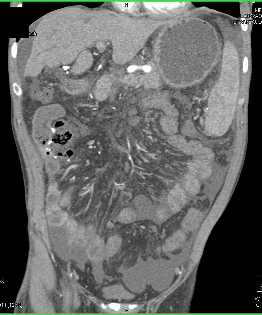 Cirrhosis with Clot in the Portal Vein and Superior Mesenteric Vein (SMV) - CTisus CT Scan