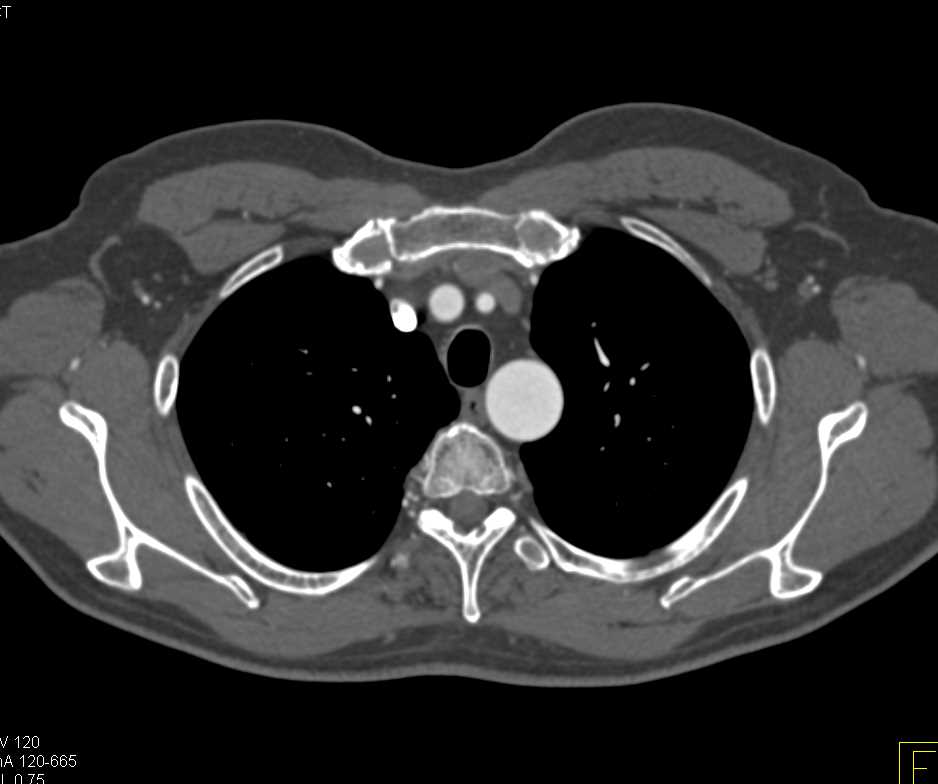 Normal Vascular Anatomy Especially Renal Artery and Veins - CTisus CT Scan