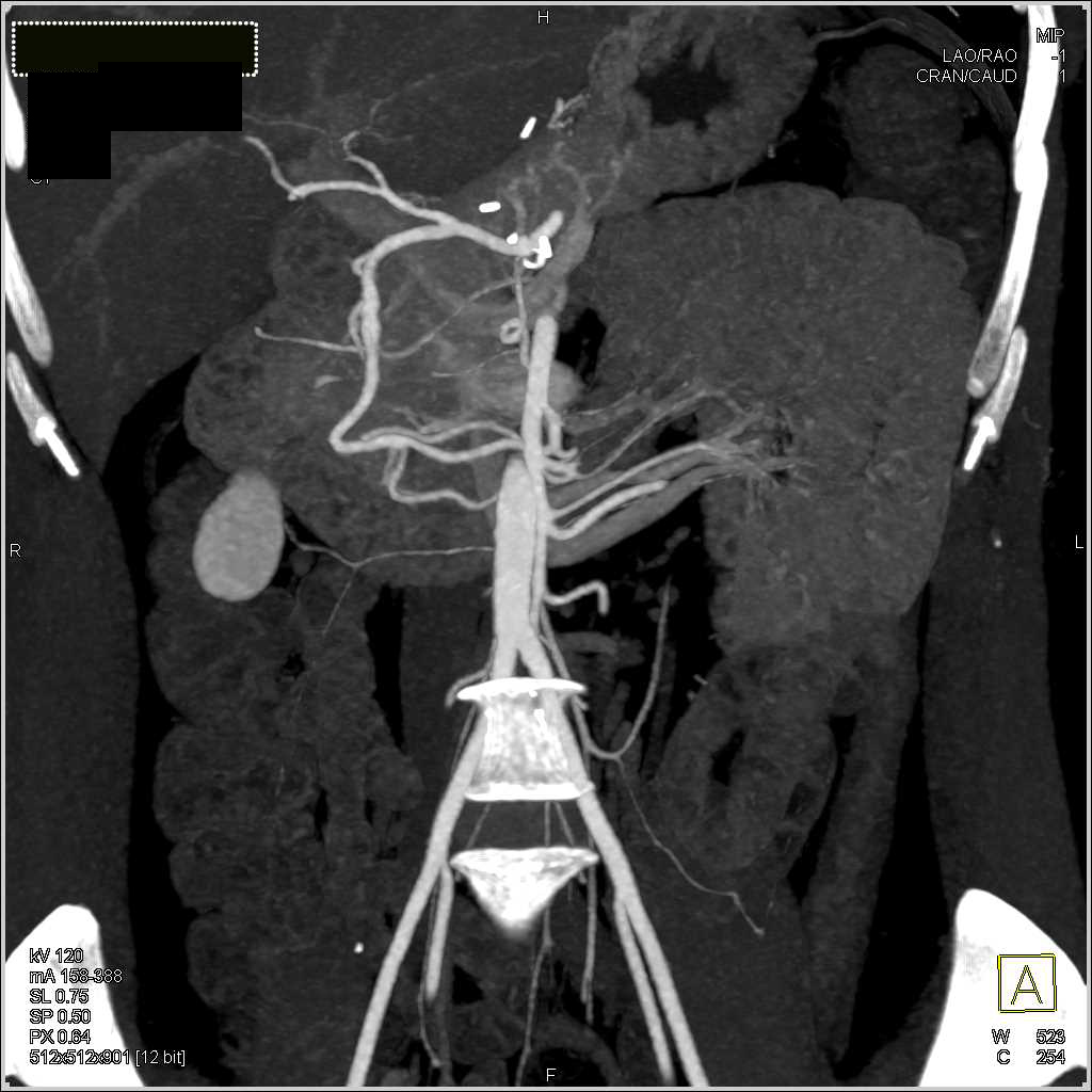 Occluded Proximal Celiac Artery Stent - CTisus CT Scan