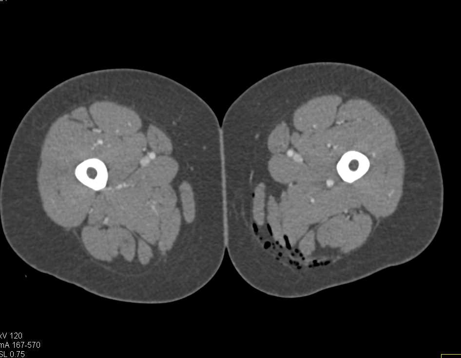 GSW Thigh Without Active Bleed with CTA - CTisus CT Scan