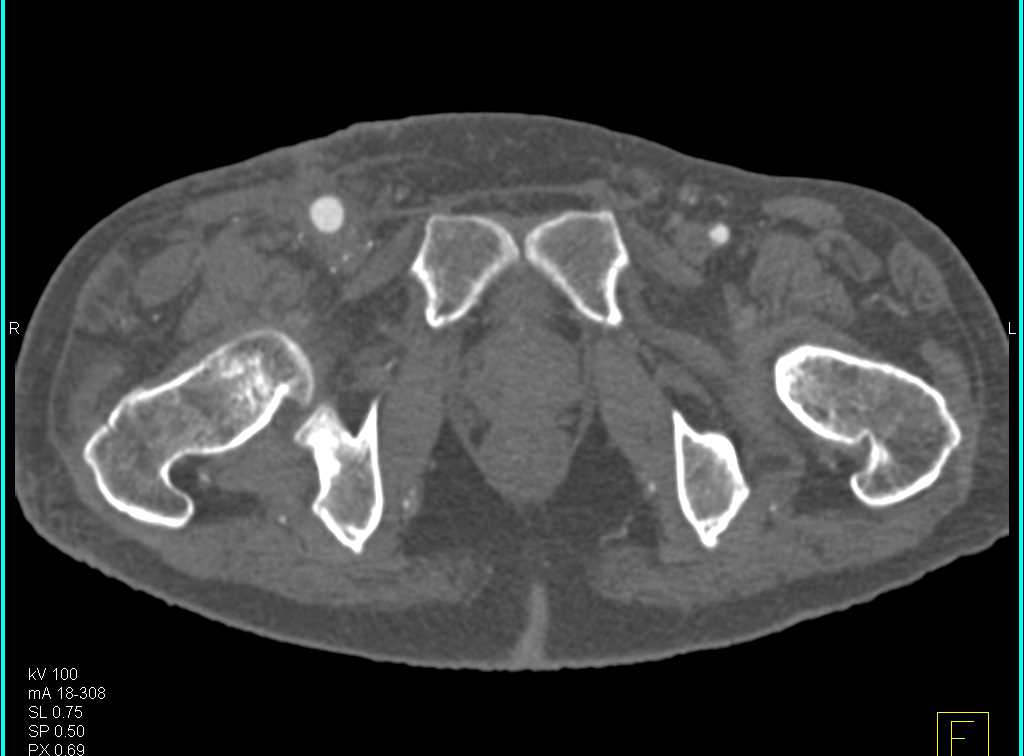 CTA Runoff with Popliteal Artery Occlusion on the Right - CTisus CT Scan