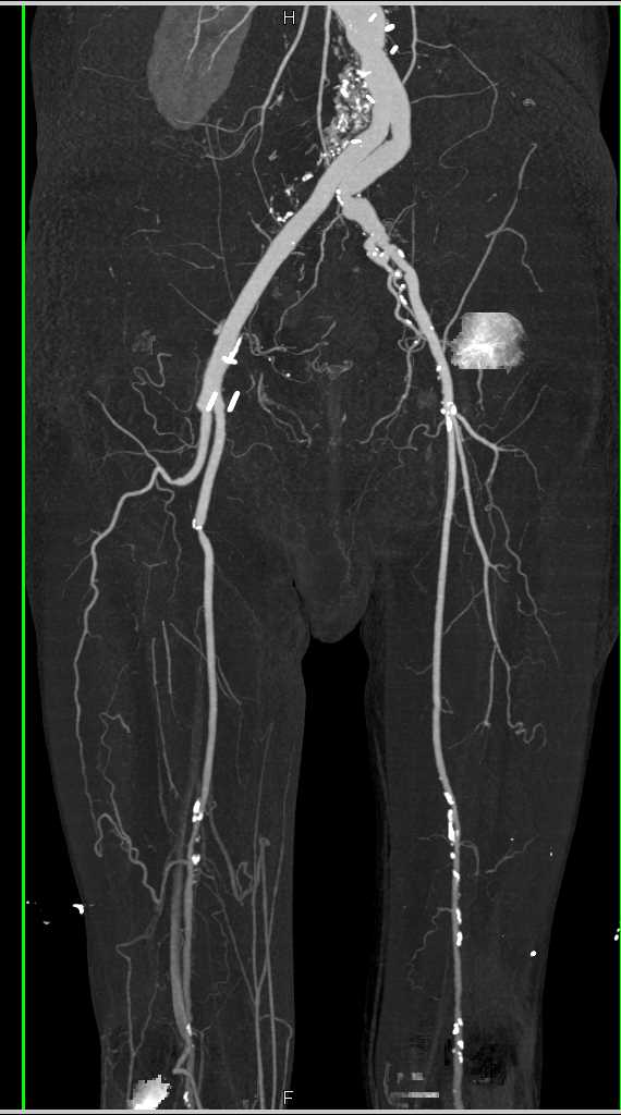 CTA DE Runoff with Grafts and Poor Trifurcation Flow - CTisus CT Scan