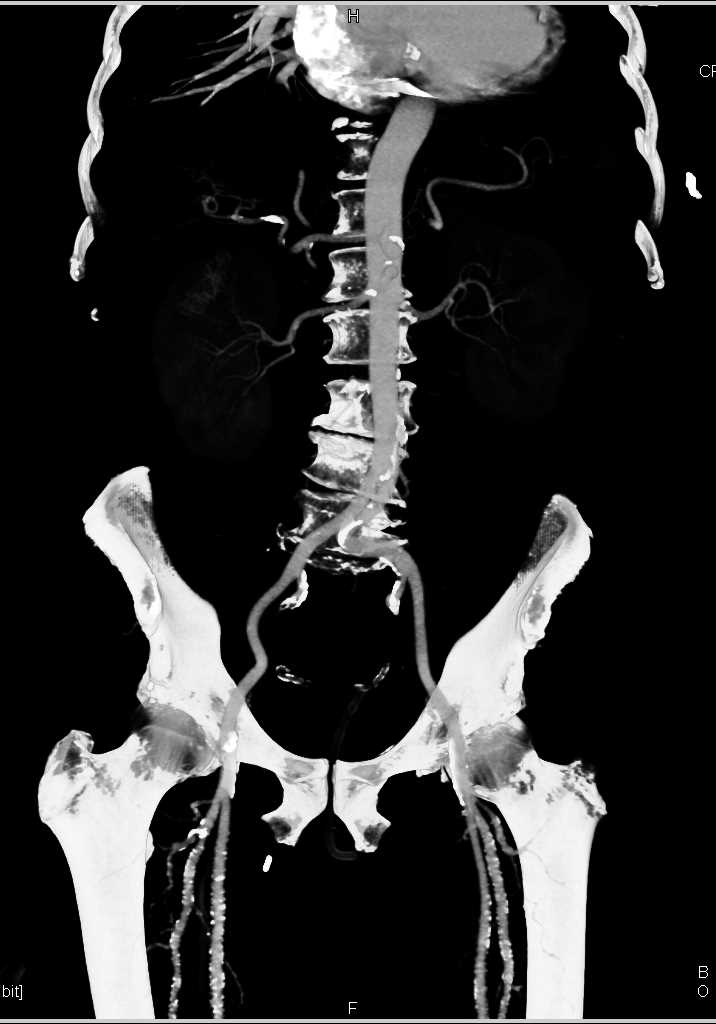 CTA DE Runoff with Extensive Calcified and Non-Calcified Plaque - CTisus CT Scan