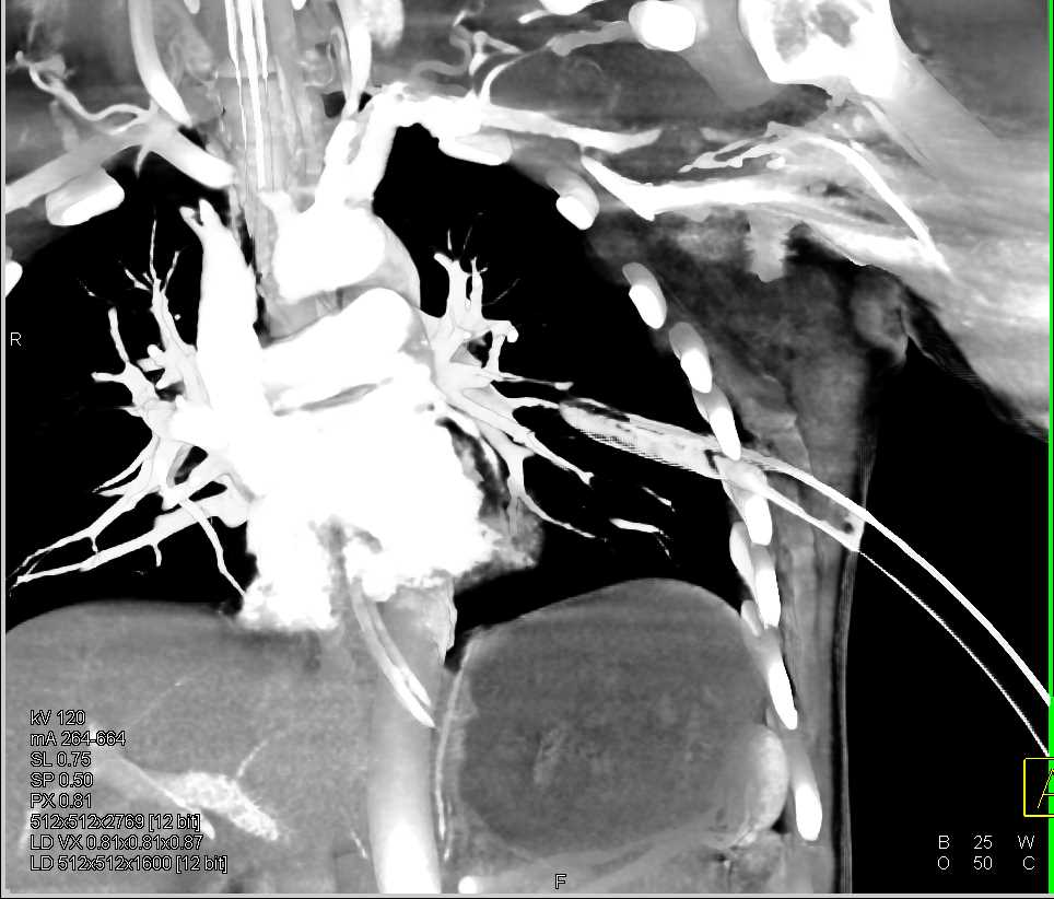 GSW with  Occlusion of the left Superficial Femoral Artery (SFA) and Popliteal Artery on CTA - CTisus CT Scan