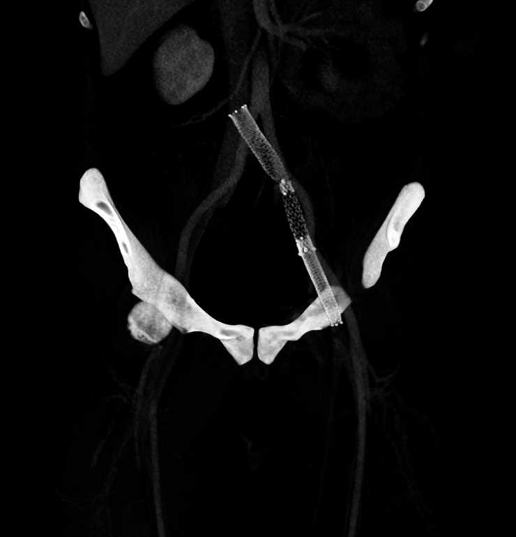 Stent in Left Common Iliac Artery in Patient with May-Thurner Syndrome (MTS) - CTisus CT Scan