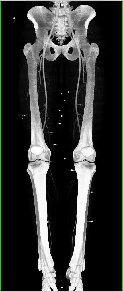 CTA Runoff with Patent Vessels - CTisus CT Scan