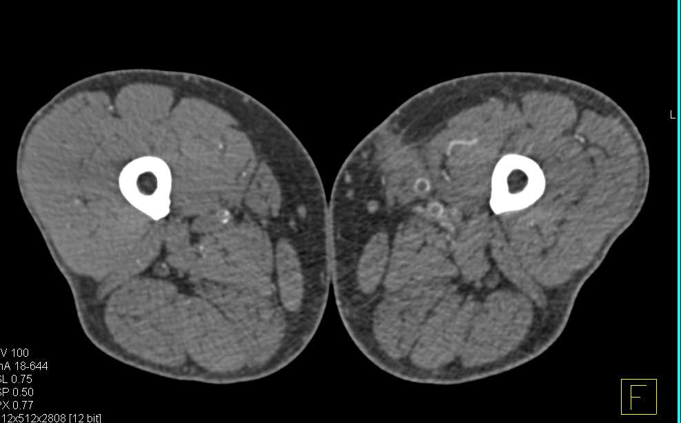 CTA Runoff with Right Superficial Femoral Artery (SFA) Occluded on DE Maps - CTisus CT Scan