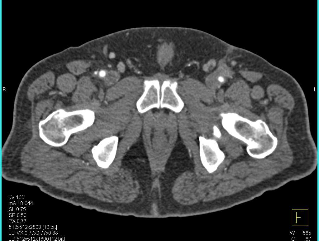 CTA Runoff with Right SFA Occluded on DE Maps as Diseased Left Superficial Femoral Artery (SFA) As Well - CTisus CT Scan