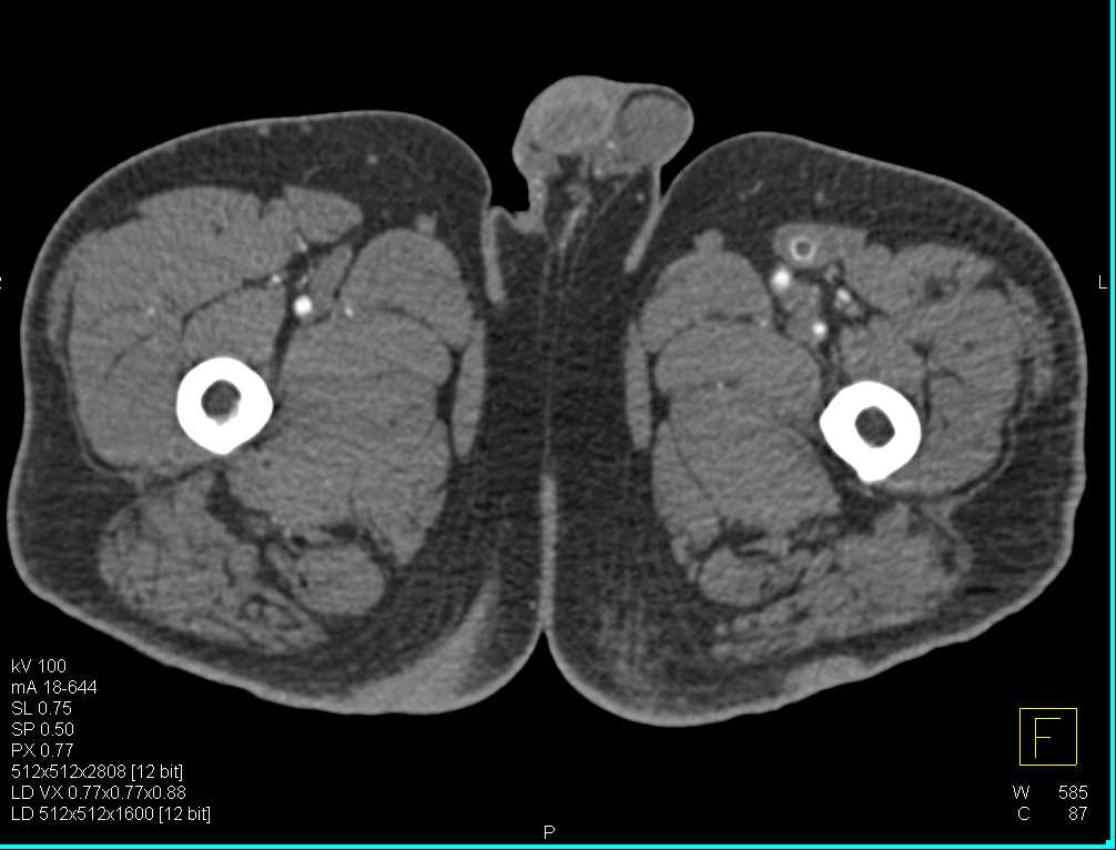 CTA with Stents in Left Superficial Femoral Artery (SFA) Occluded - CTisus CT Scan