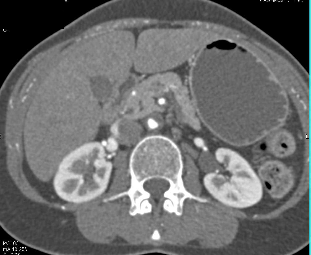 Aortic Occlusion with Small Caliber Iliac Arteries on CTA (Leriche Syndrome) - CTisus CT Scan