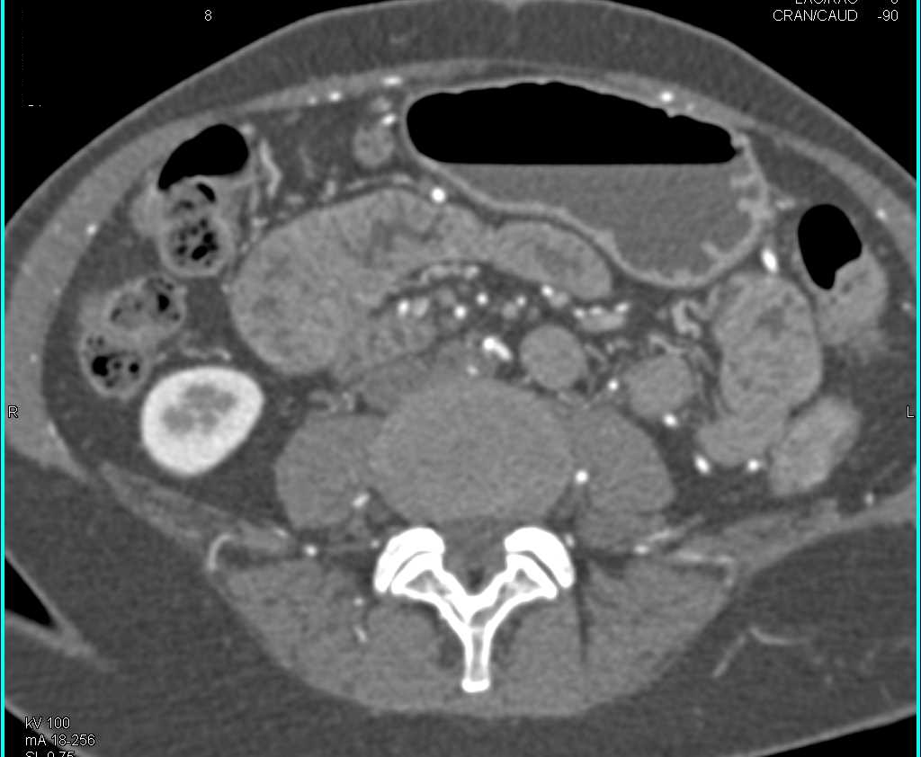 Aortic Occlusion with Small Caliber Iliac Arteries on CTA (Leriche Syndrome) - CTisus CT Scan