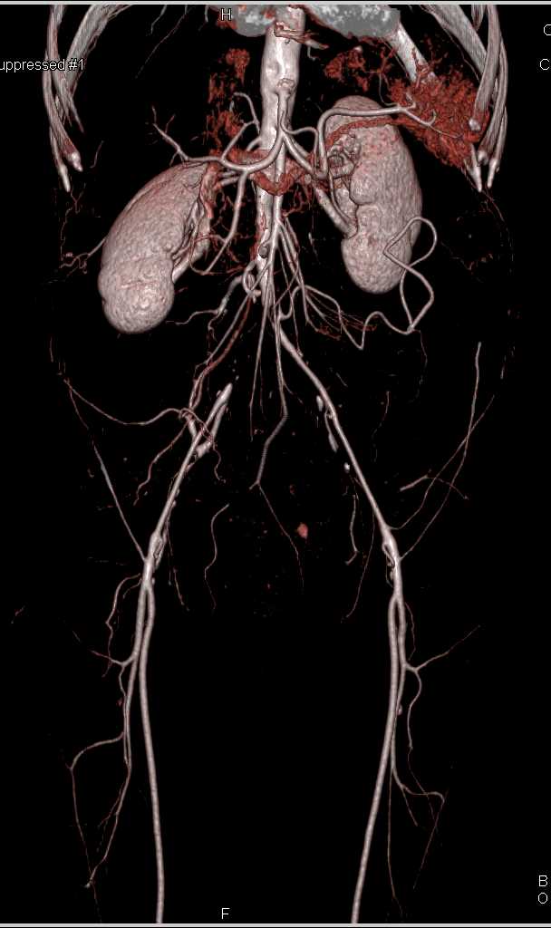 Aortic Occlusion with Small Caliber Iliac Arteries on CTA (Leriche Syndrome) - CTisus CT Scan