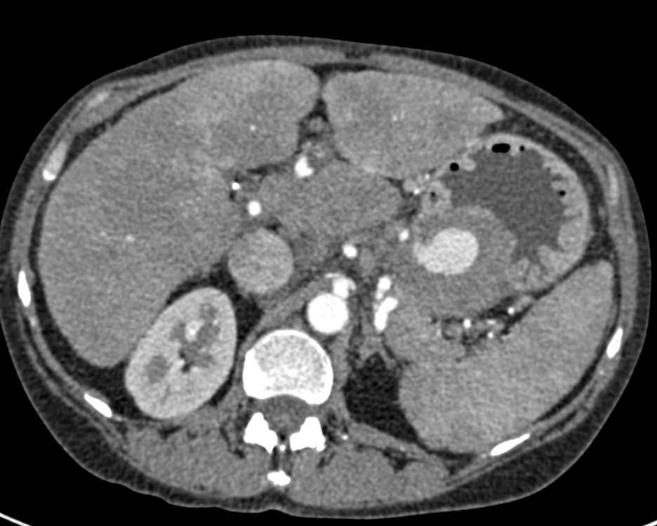 Splenic Artery Pseudoaneurysm - CTisus CT Scan