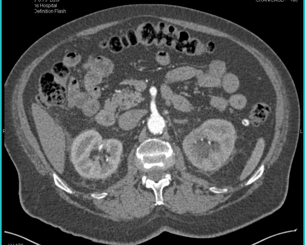 Perianeurysmal Fibrosis Around the Aorta - CTisus CT Scan