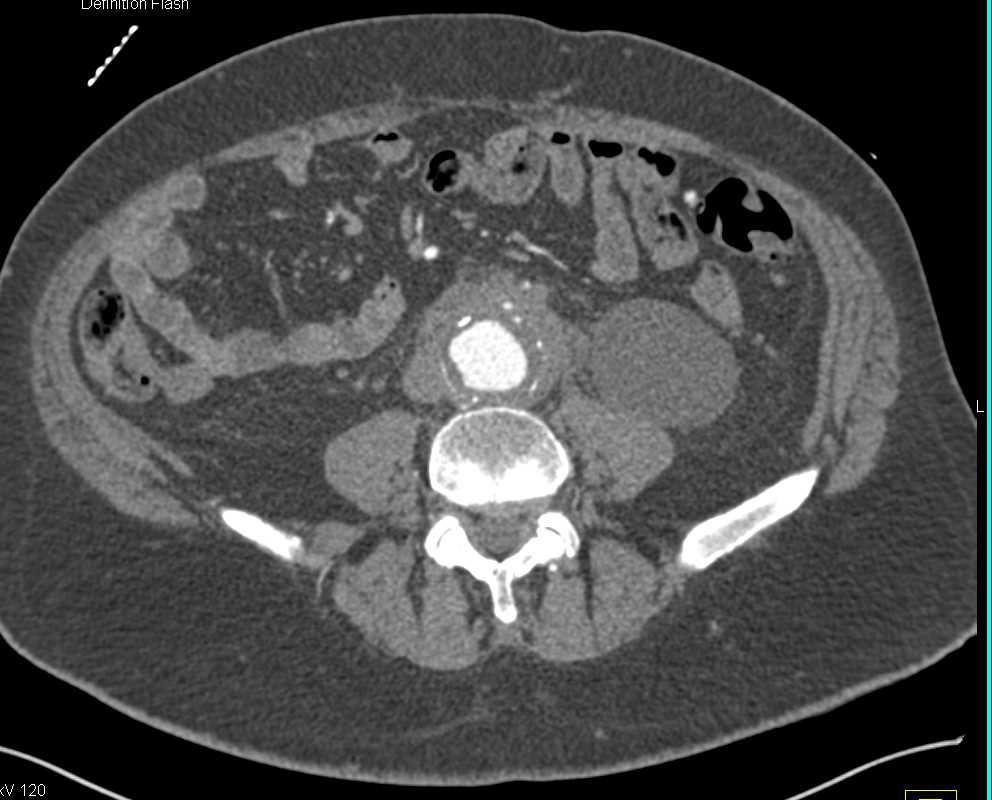 Perianeurysmal Fibrosis Around the Aorta - CTisus CT Scan