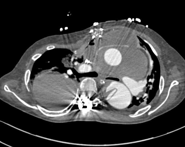 Aortic Dissection Extends into the Abdominal Aorta - CTisus CT Scan