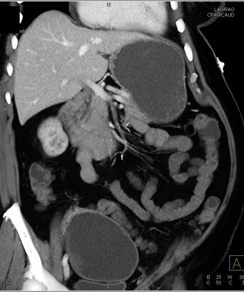 Occlusion of the Superior Mesenteric Artery (SMA) with Thrombus and Incidental Bladder Cancer - CTisus CT Scan