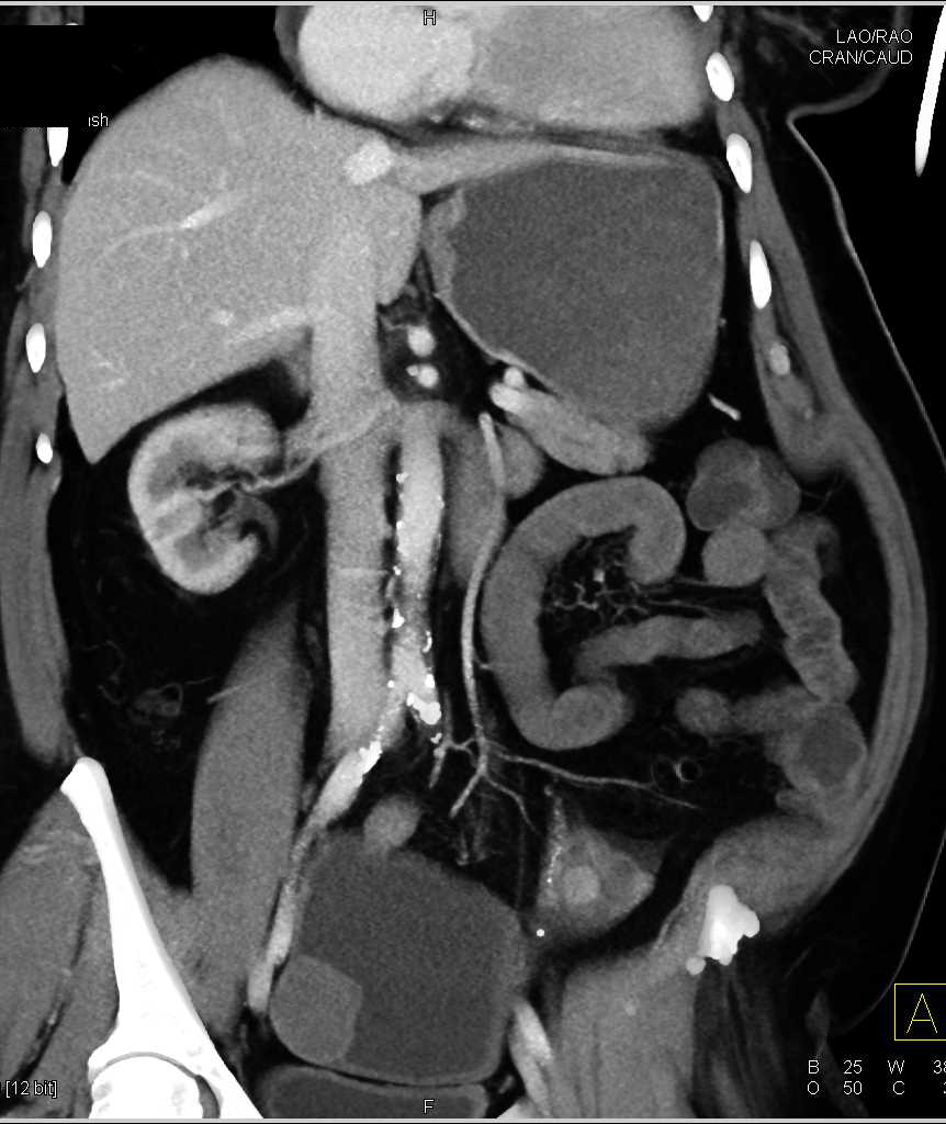 Occlusion of the Superior Mesenteric Artery (SMA) with Thrombus - CTisus CT Scan